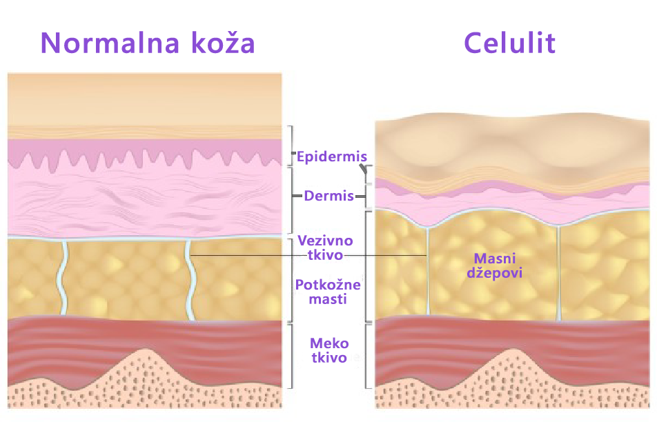 Kako nastaje Celulit